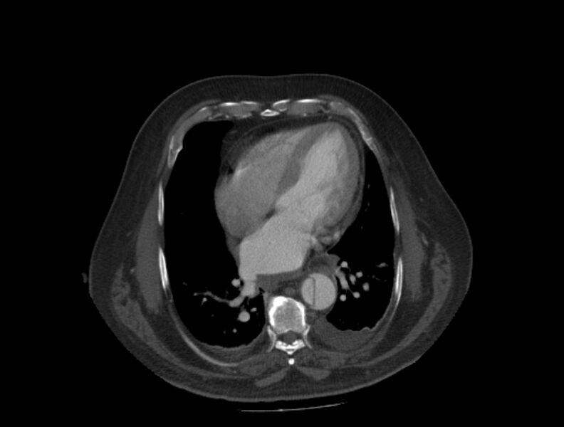 File:Aortic dissection (Radiopaedia 28802-29105 A 26).jpg