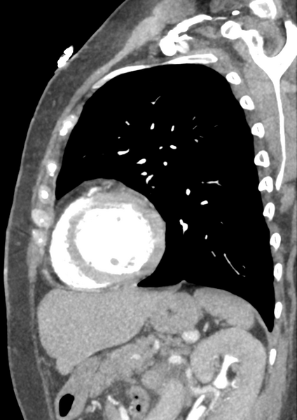 File:Aortic dissection - Stanford type B (Radiopaedia 50171-55512 C 9).png