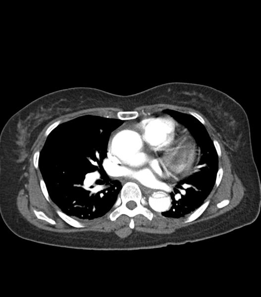 File:Aortic dissection with renal ischemia (Radiopaedia 76573-88338 A 35).jpg