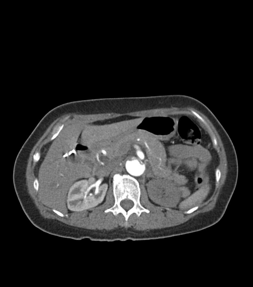 Aortic dissection with renal ischemia (Radiopaedia 76573-88338 A 64).jpg