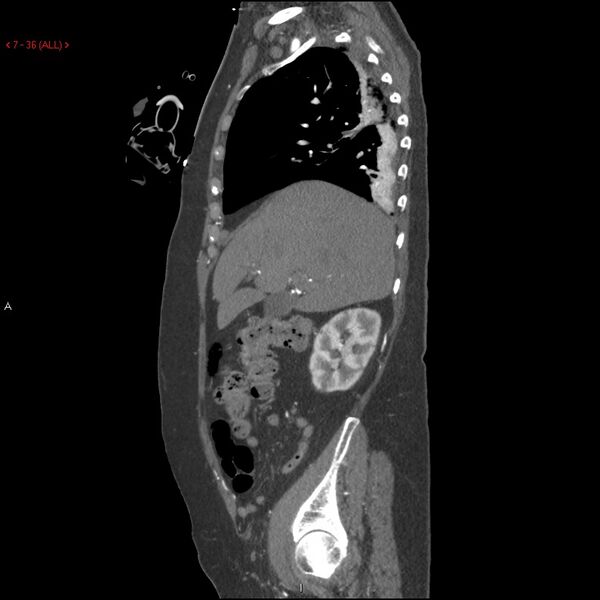 File:Aortic intramural hematoma (Radiopaedia 27746-28001 C 5).jpg