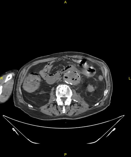 File:Aortoenteric fistula (Radiopaedia 84308-99603 Axial non-contrast 169).jpg