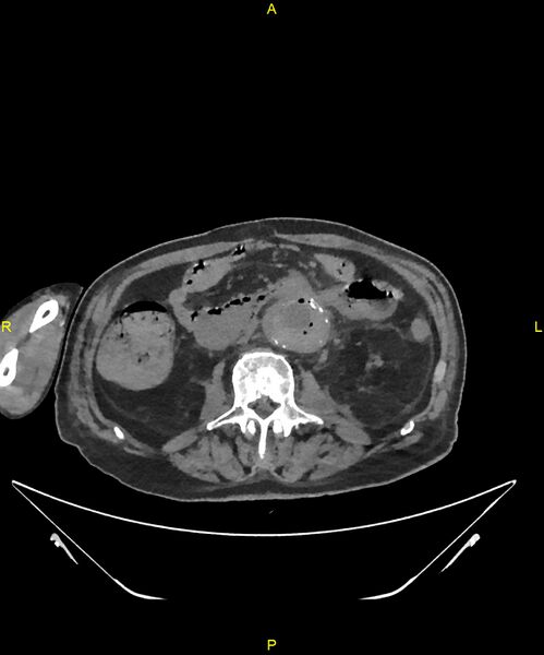 File:Aortoenteric fistula (Radiopaedia 84308-99603 Axial non-contrast 179).jpg