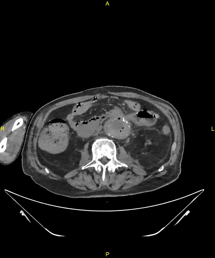 Aortoenteric fistula (Radiopaedia 84308-99603 Axial non-contrast 179).jpg