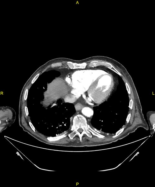 File:Aortoenteric fistula (Radiopaedia 84308-99603 B 6).jpg
