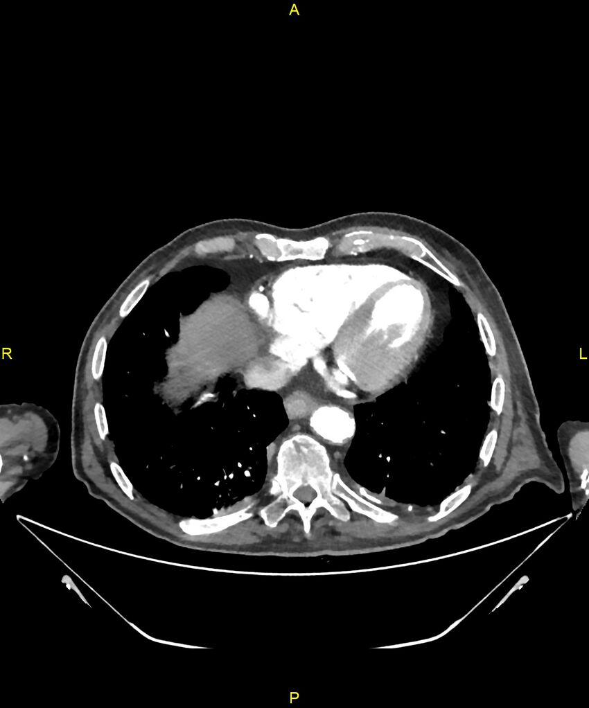 Aortoenteric fistula (Radiopaedia 84308-99603 B 6).jpg