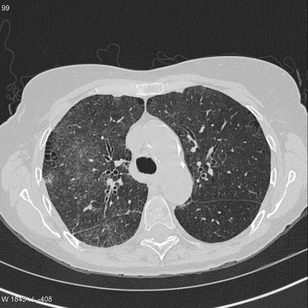 File:Apical non-small-cell lung cancer (Radiopaedia 8570-9405 Axial lung window 16).jpg