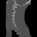 Apical pneumothorax on cervical spine CT (Radiopaedia 45343-49368 Sagittal bone window 5).jpg