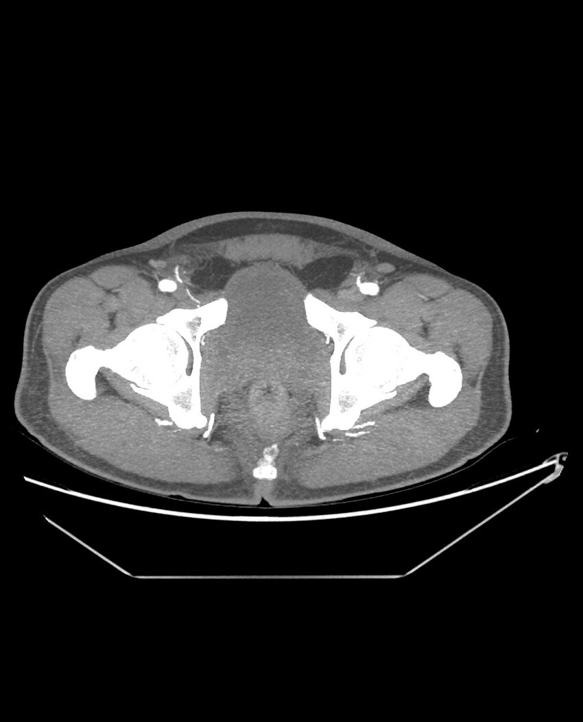 Aplastic posterior tibial arteries (Radiopaedia 84021-99249 A 99).jpg