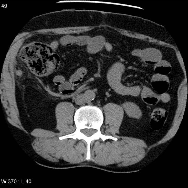File:Appendicitis (Radiopaedia 12510-12733 Axial non-contrast 16).jpg