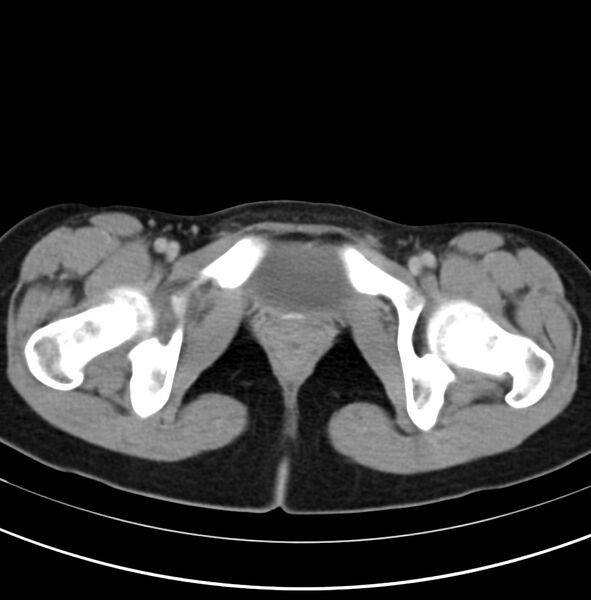 File:Appendicitis and incidental bicornuate uterus (Radiopaedia 22833-22853 Axial C+ delayed 41).jpg