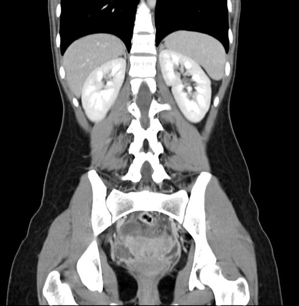 File:Appendicitis and incidental bicornuate uterus (Radiopaedia 22833-22853 D 31).jpg