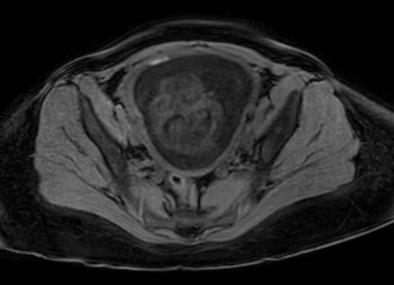 File:Appendicitis in gravida (MRI) (Radiopaedia 89433-106395 Axial DIXON 123).jpg