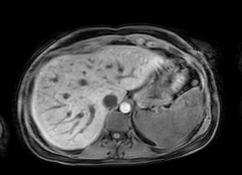 File:Appendicitis in gravida (MRI) (Radiopaedia 89433-106395 Axial DIXON 17).jpg