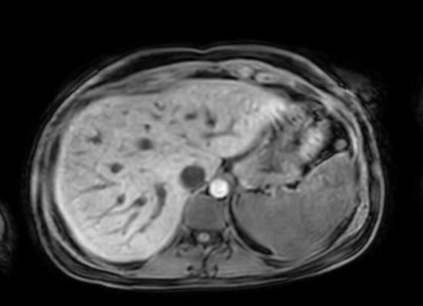 Appendicitis in gravida (MRI) (Radiopaedia 89433-106395 Axial DIXON 17).jpg