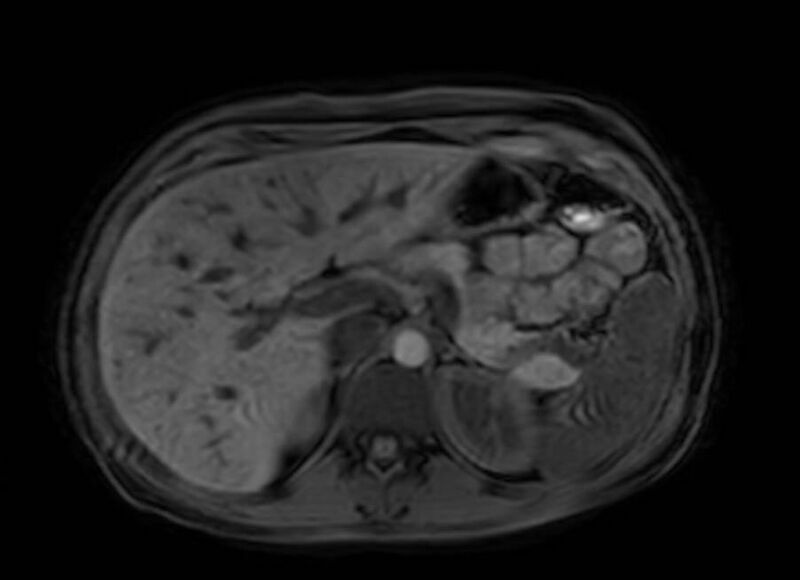 File:Appendicitis in gravida (MRI) (Radiopaedia 89433-106395 Axial DIXON 29).jpg