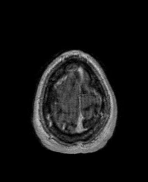 File:Arachnoid cyst- extremely large (Radiopaedia 68741-78451 Axial T1 C+ 74).jpg