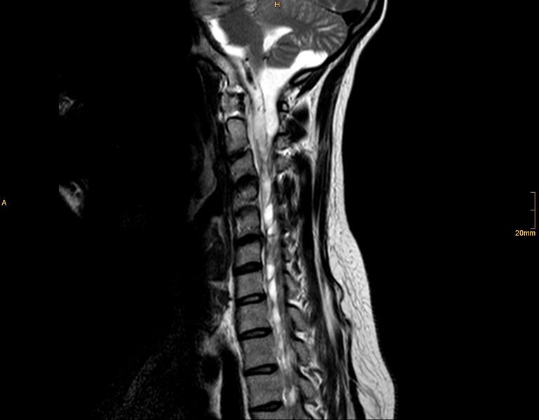 File:Arachnoid cyst - spinal (Radiopaedia 10055-10597 T2 3).jpg