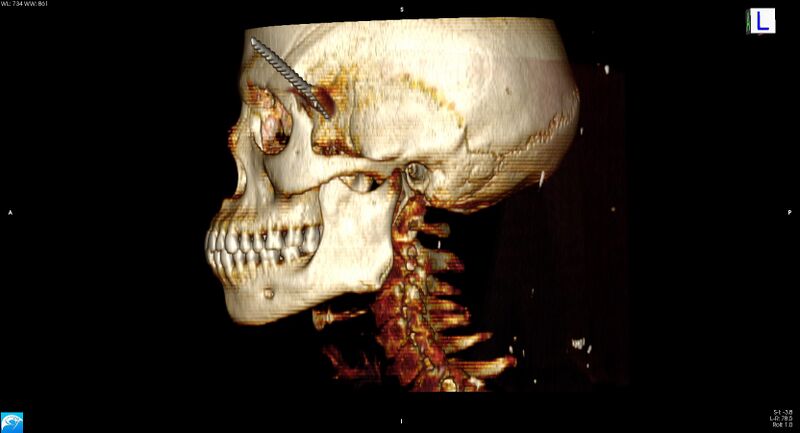 File:Arrow injury to the head (Radiopaedia 75266-86388 3D horizontal 19).jpg