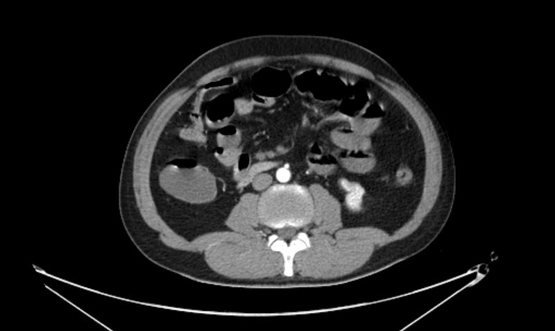 File:Arterial occlusive mesenteric ischemia (Radiopaedia 84641-100060 A 68).jpg