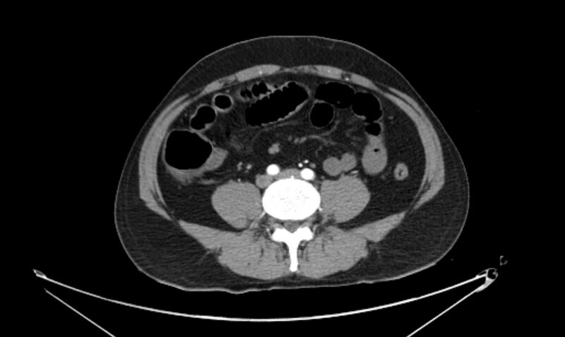 File:Arterial occlusive mesenteric ischemia (Radiopaedia 84641-100060 A 85).jpg