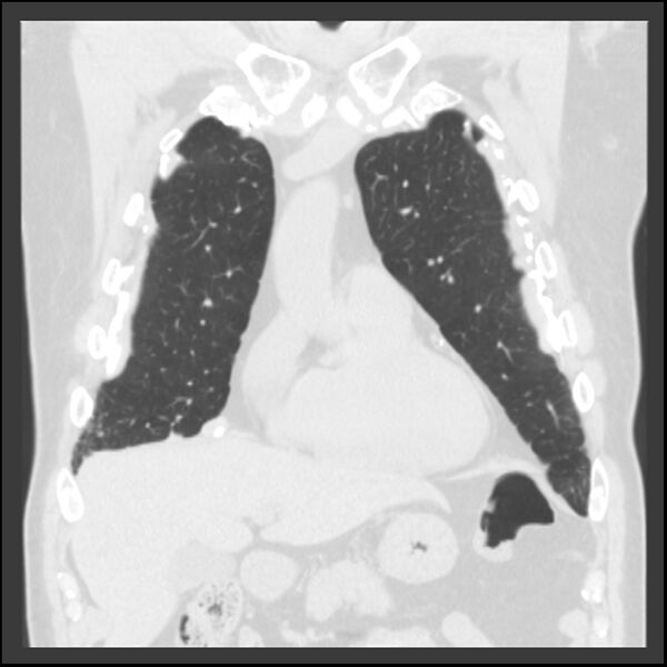 File:Asbestos-related pleural plaques (Radiopaedia 39069-41255 Coronal lung window 66).jpg