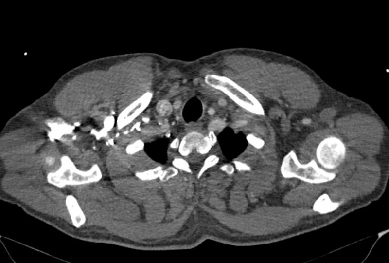 File:Ascending aortic aneurysm (Radiopaedia 86279-102297 C 2).jpg