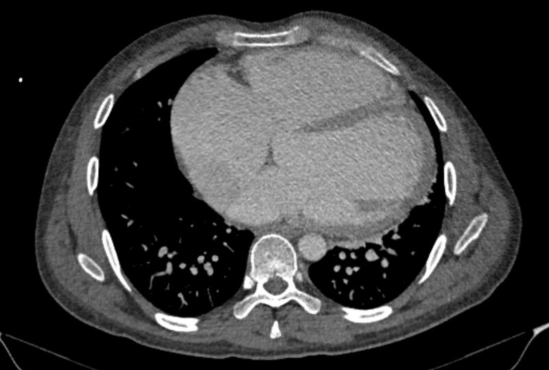 File:Ascending aortic aneurysm (Radiopaedia 86279-102297 C 42).jpg