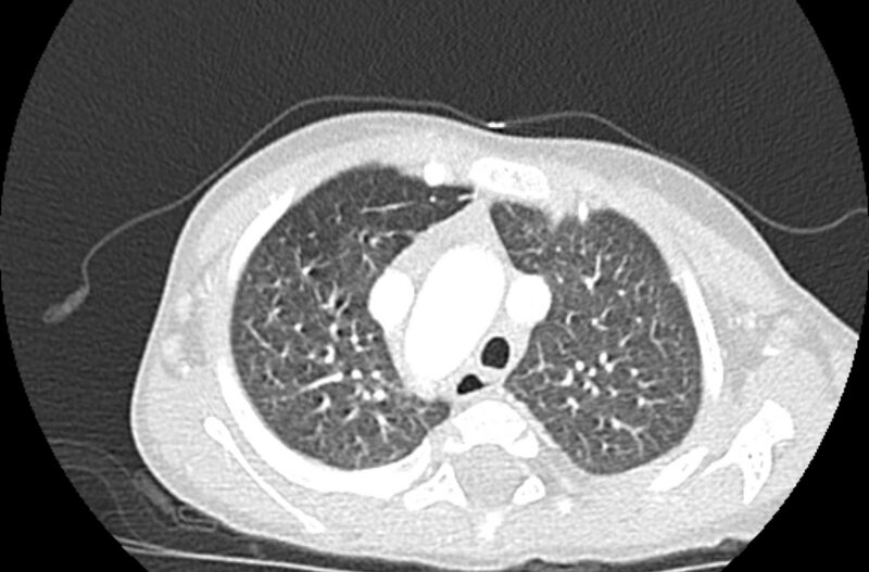 File:Asplenia syndrome (Radiopaedia 73083-83792 Axial lung window 16).jpg