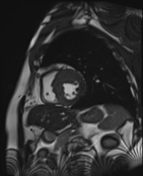 File:Asymmetric septal hypertrophic cardiomyopathy - systolic anterior motion of mitral leaflet (Radiopaedia 72795-83445 C 24).jpg