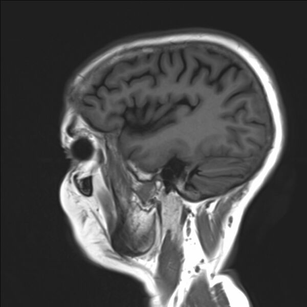 File:Atlanto-occipital assimilation with basilar invagination (Radiopaedia 70122-80157 Sagittal T1 19).jpg
