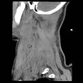 Atlanto-occipital dislocation (Radiopaedia 44648-48412 A 1).jpg