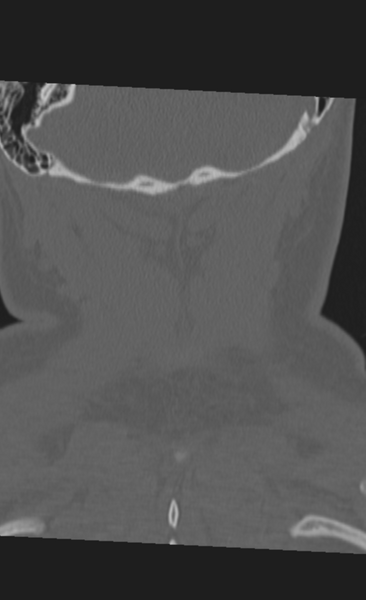File:Atlanto-occipital dissociation (Radiopaedia 33848-35013 Coronal bone window 50).png
