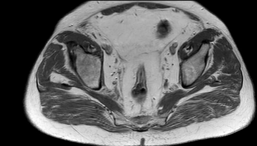 Atypical lipomatous tumor - thigh (Radiopaedia 68975-78734 Axial T1 100).jpg