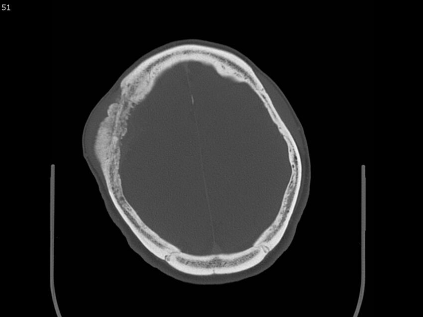 Atypical meningioma - intraosseous (Radiopaedia 64915-73867 Axial C+ bone window 51).jpg