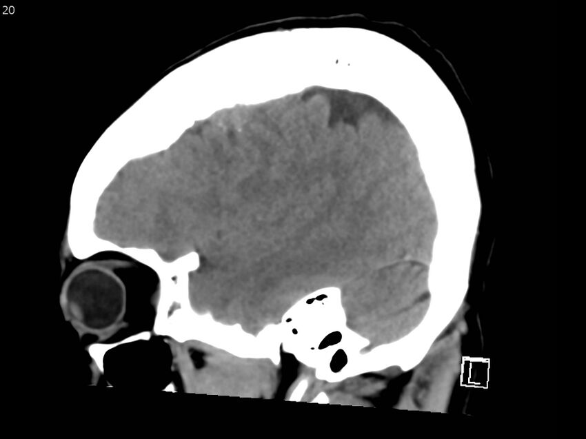 Atypical meningioma - intraosseous (Radiopaedia 64915-73867 C 18).jpg