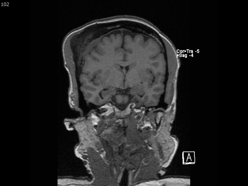 File:Atypical meningioma - intraosseous (Radiopaedia 64915-74572 Coronal T1 102).jpg