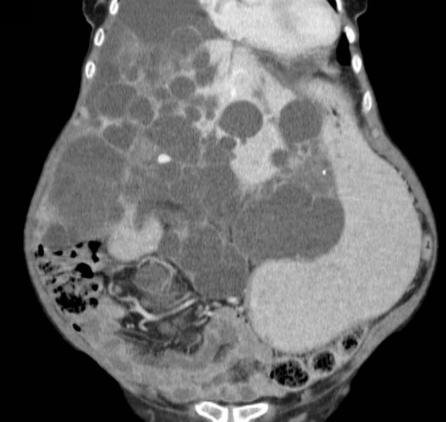 File:Autosomal dominant polycystic kidney disease (Radiopaedia 16777-16490 B 13).jpg