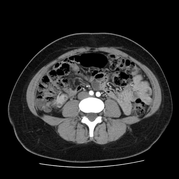 File:Autosomal dominant polycystic kidney disease (Radiopaedia 23061-23093 B 42).jpg