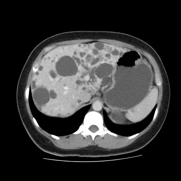 File:Autosomal dominant polycystic kidney disease (Radiopaedia 23061-23093 C 15).jpg