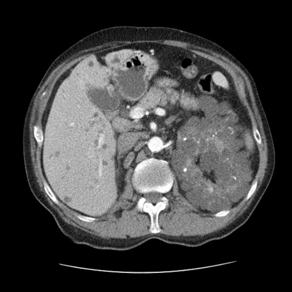 File:Autosomal dominant polycystic kidney disease (Radiopaedia 27851-28094 B 65).jpg