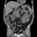 Autosomal dominant polycystic kidney disease (Radiopaedia 36539-38101 C 30).jpg
