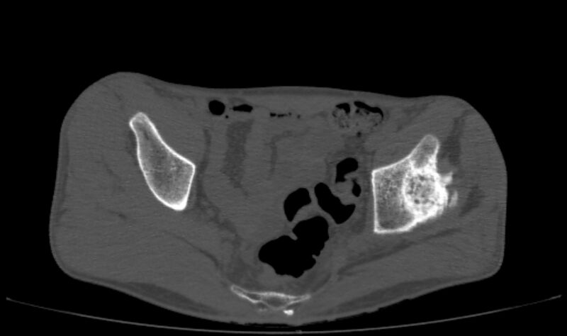 File:Avascular necrosis of the left hip (Radiopaedia 75068-86125 Axial bone window 15).jpg