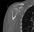 Avulsion fracture - greater tuberosity of humerus (Radiopaedia 71216-81514 Coronal bone window 23).jpg