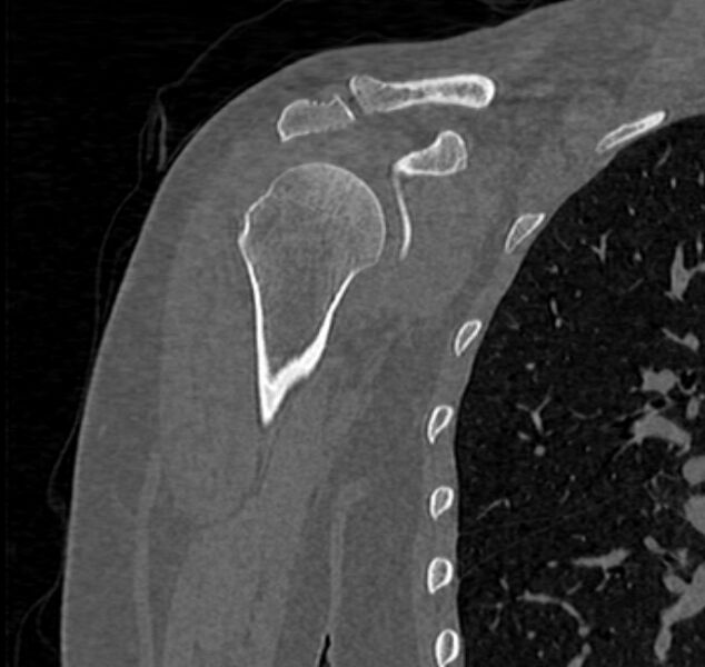 File:Avulsion fracture - greater tuberosity of humerus (Radiopaedia 71216-81514 Coronal bone window 23).jpg