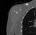 Avulsion fracture - greater tuberosity of humerus (Radiopaedia 71216-81514 Coronal bone window 3).jpg