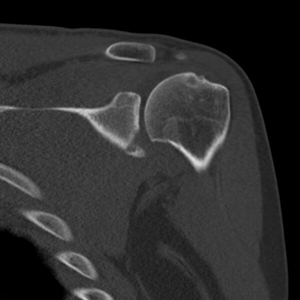 File:Bankart lesion (Radiopaedia 22771-22798 Coronal bone window 17).jpg