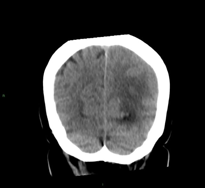 File:Basal ganglia hemorrhage (Radiopaedia 58759-65981 Coronal non-contrast 20).jpg