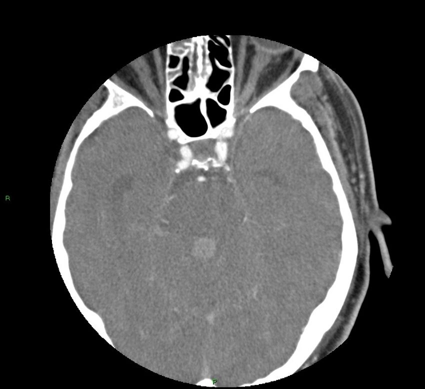 Basal ganglia hemorrhage (Radiopaedia 58763-65985 D 68).jpg