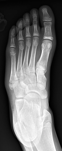 File:Base of 5th metatarsal apophysis and fracture (Radiopaedia 30847-31560 Frontal 1).png